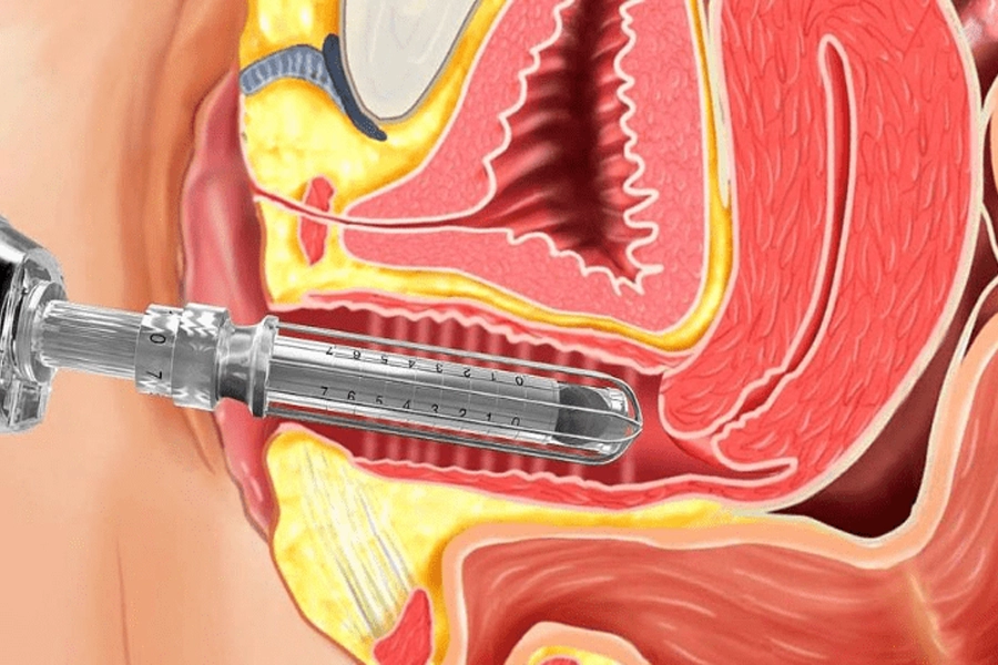 Genital Gençleştirme