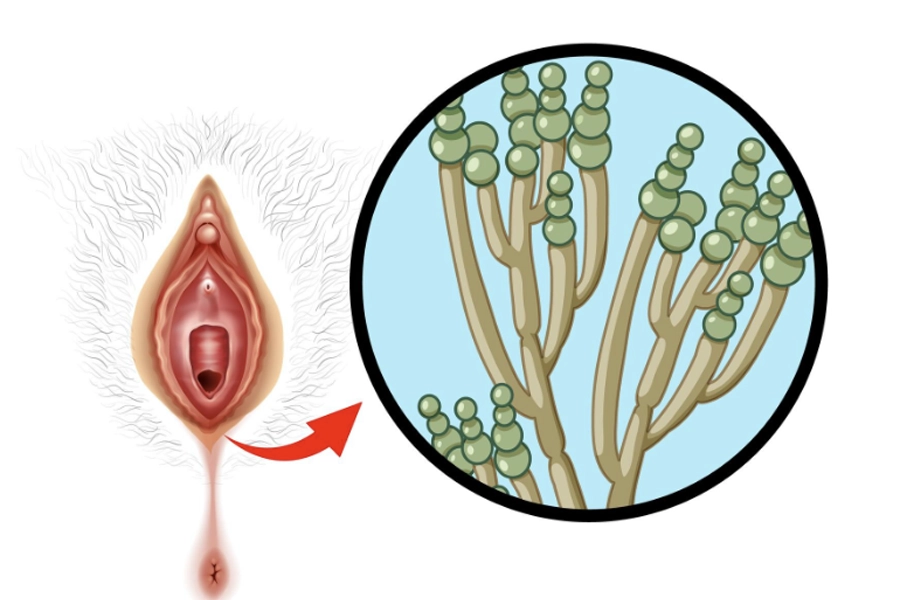 Genital Siğil Tekrarlar mı?